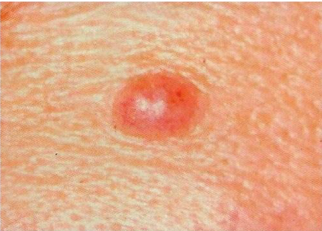 Melanoma checker - skin picture