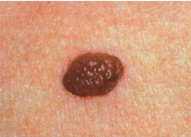 Melanoma checker - skin picture