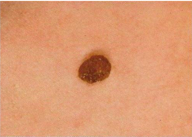 Melanoma checker - skin picture