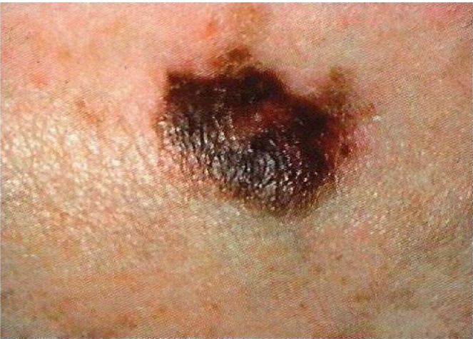 Melanoma checker - skin picture