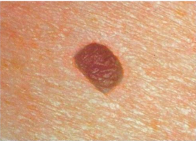 Melanoma checker - skin picture