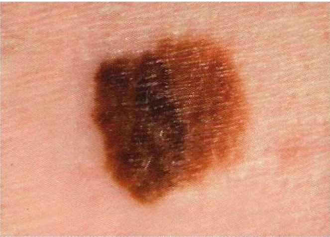 Melanoma checker - skin picture