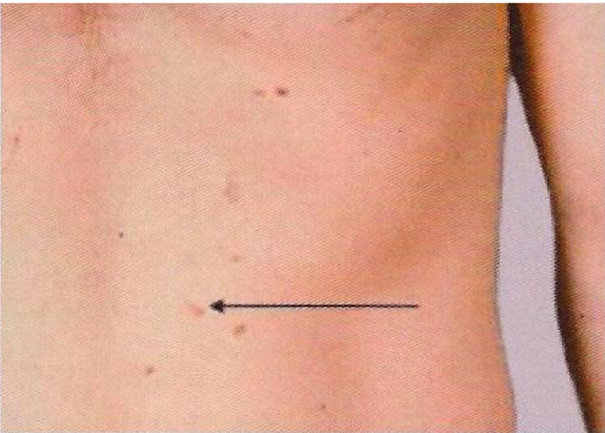 Melanoma checker - skin picture