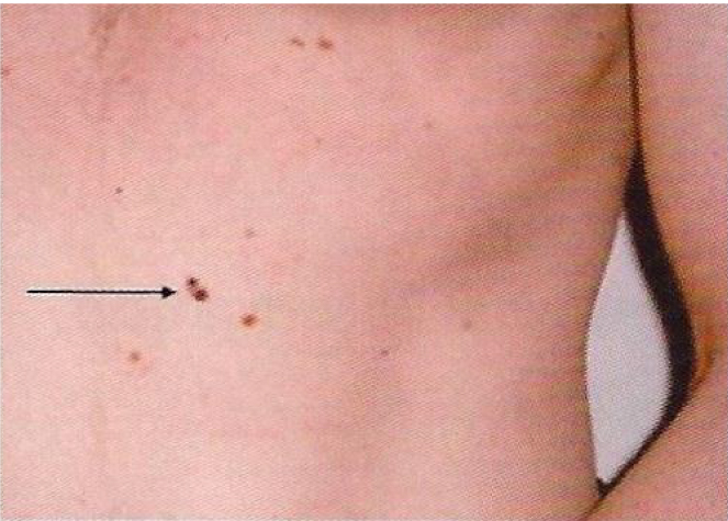 Melanoma checker - skin picture